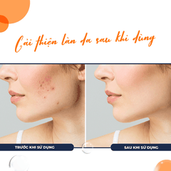 GEL GIÚP TRỊ MỤN, KHÁNG KHUẨN, KIỂM SOÁT DẦU NHỜN BAN NGÀY SALYZAP GEL FOR ACNE DAY TIME-FIXDERMA TUÝP 20G