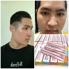 KEM TRỊ MỤN, GIẢM NẾP NHĂN TRẺ HÓA DA TRETIOIN - MENARINI