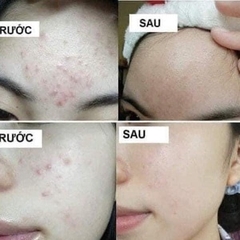 GEL TRỊ MỤN XÓA THÂM DO MỤN MEGADUO - GAMMA