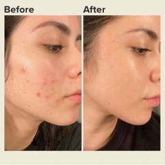 GEL TRỊ MỤN NGỪA THÂM DERMA FORTE - GAMMA