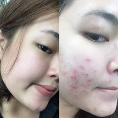 KEM TRỊ MỤN HÀN QUỐC PAIR ACNE - LION