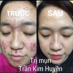 KEM MỤN DƯỠNG DA THẢO MỘC TKH - HỒNG ÁNH STORE