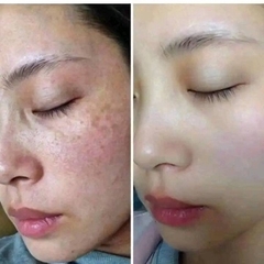 TUÝP KEM MỜ NÁM TÀN NHANG, MỤN CLOBETAMIL 25G KT1- GDN