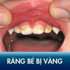 GEL NGỪA SÂU RĂNG, MÒN RĂNG, MỦN RĂNG VECNI FLUOR - ANAMELAST