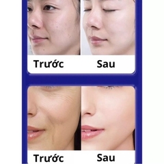 KEM GIẢM NÁM, CHỐNG NHĂN VÀ TRẺ HÓA DA UCM NHẬT BẢN - GDN