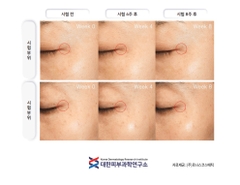 Tinh chất Filler Vitamin C 13.5% LAVASOME  10 ống x 5g  Hàn Quốc