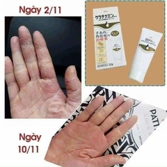 KOWA- Kem trị á sừng, viêm da cơ địa 30g