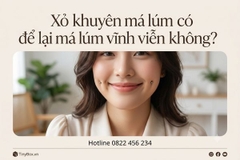 Xỏ khuyên má lúm có để lại má lúm vĩnh viễn không?