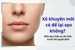 Xỏ khuyên môi có để lại sẹo không? Điều bạn thật sự cần biết trước khi quyết định