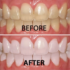 Máy tẩy trắng răng tại nhà IVISMILE Extra V5, 32 LED, tẩy trắng răng an toàn, hiệu quả sau 7 ngày - chuẩn EU