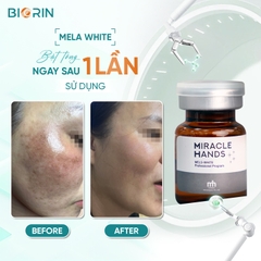 Meso nám - Tinh chất giảm nám - giảm thâm mụn - các vấn đề về sắc tố da #MELA #WHITE