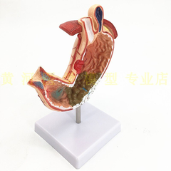 MÔ HÌNH GIẢNG DẠY BỆNH LÝ DẠ DÀY