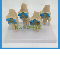 MÔ HÌNH GIẢNG DẠY BỆNH LÝ KHỚP GỐI