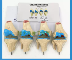 MÔ HÌNH GIẢNG DẠY BỆNH LÝ KHỚP GỐI