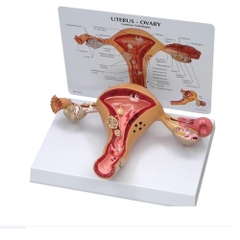 MÔ HÌNH BỆNH LÝ TỬ CUNG VÀ BUỒNG TRỨNG NGƯỜI