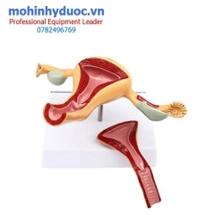 MÔ HÌNH TỬ CUNG - VÒI TRỨNG - BUỒNG TRỨNG BỆNH LÝ