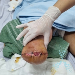 Lành vết loét do đái tháo đường sau đoạn 1/2 chi phải
