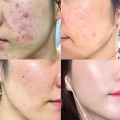 Set sum xanh cấp nước trị mụn 2sp 115kw (8ae)