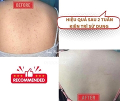 Xịt mụn lưng Angel’s Liquid Glutathion 150ml ( 50ea)