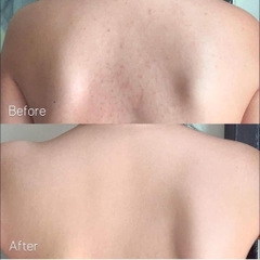 Xịt mụn lưng Angel’s Liquid Glutathion 150ml ( 50ea)