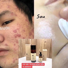 Tinh chất trị mụn  jangstem bệnh viện vands clinic 24kw