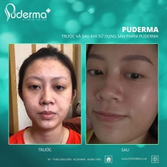Tế Bào Gốc PUDERMA BIO- ĐỎ, PHÁ NÁM: Làm mờ vết nám, tàn nhang, đồi mồi, vết thâm, tái tạo da..