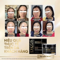 Kem Nám Đêm Spotreat Radiance Complex LYCOS – Giảm Thâm Nám, Dưỡng Trắng, Cải Thiện Da Không Đều Màu