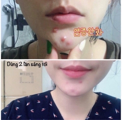 Kem Trị Mụn Dalacin T Gel 1% (10G)