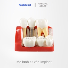 Mẫu hàm tư vấn so sánh cầu răng và implant - Mô hình tư vấn nha khoa