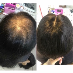 Phủ hói không mái 25cm