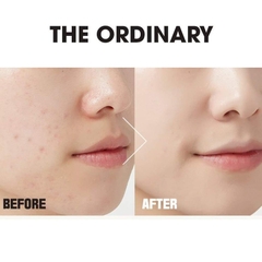 Serum The Ordinary Niacinamide 10% + Zinc 1% Kiềm Dầu Giảm Mụn - Fullbox - Hàng US