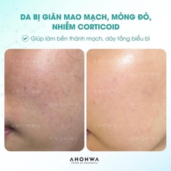 Kem Ahohwa Vitamin K Cream 12g Phục Hồi Giảm Thâm Đỏ Da - Nobox - Hàng Công Ty