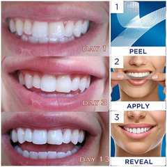 Dán răng Crest 3D Whitestrips Professional Effects Levels 19 whiter in 22 days - 44 strips Fullbox Order US
