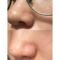 Dụng Cụ Làm Sạch Mụn Đầu Đen ILSO Deep Clean Master