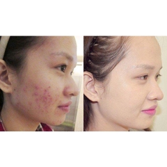 SRM Compliment No Problem - ĐỎ SALICYLIC ACID 200ml
