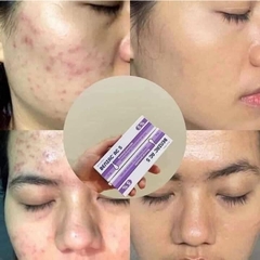Kem Chấm Mụn Benzac AC5 5% Benzoyl Preoxide Hỗ Trợ Gom Cồi Mụn Giảm Sưng Viêm Hiệu Quả Pháp - Tuýp 15g