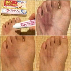 Kem Mờ Sẹo Kobayashi - XANH GEL Tuýp 15g