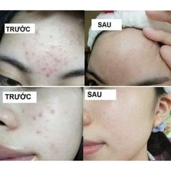 Gel Megaduo Giảm Mụn Ngừa Thâm Megaduo Gel Việt Nam - Tuýp 15g