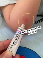 Kem Rokoito Locoid Ointment Bôi Vết Đốt Côn Trùng Muỗi Đốt 5g Nhật Bản