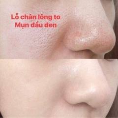 Tinh Chất SQS Siêu Se Khít Lỗ Chân Lông Nhật Bản 15ml