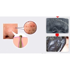 Gel Làm Sạch Mụn Đầu Đen Kose Softymo Hot Cleansing Tuýp 25g