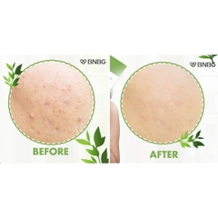 Mặt Nạ BNBG Vita Tea Tree Healing Face Mask Pack Làm Dịu Giảm Mụn Hàn Quốc