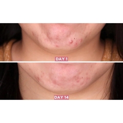 Serum Some By Mi AHA BHA PHA 30 Days Miracle Chai 50ml