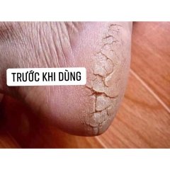 Kem Á Sừng Kowa Giảm Nứt Nẻ Khô Ráp Keratinamin Cream Nhật 30g