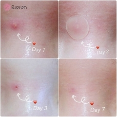 Miếng Dán Mụn Cosrx Acne Pimple Master Patch