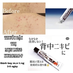 Kem Làm Giảm Mụn Lưng Kuromai P Ointment Nhật Bản