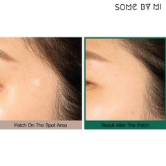 Miếng Dán Mụn Some By Mi Acnes Clear Spot Patch - 18 miếng