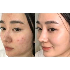 Gel Chấm Mụn Compliment No Problem AHA BHA PHA Giảm Sưng Viêm Ngăn Mụn 25ml Nga