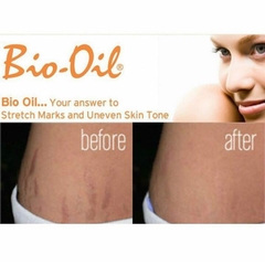 Tinh Dầu Rạn Da Bio-Oil Úc Nhẹ Dịu Giảm Rạn Da Hiệu Quả