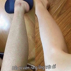 [TL]Kem Kela Lotion Đặc Trị Viêm Da, Viêm Nang Lông 30ml